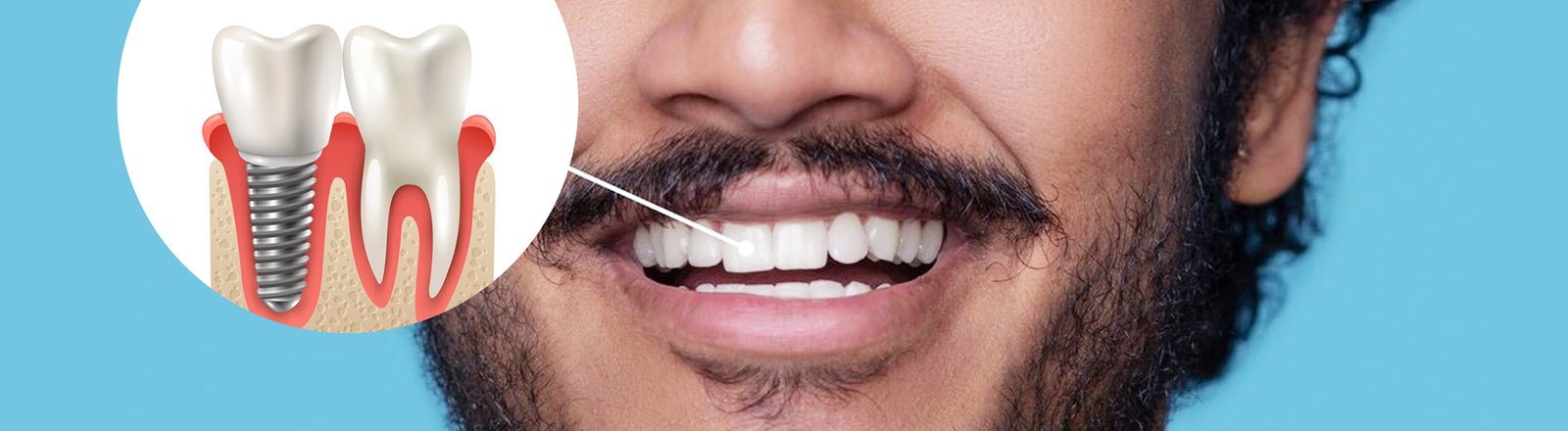 clear aligners Like A Pro With The Help Of These 5 Tips